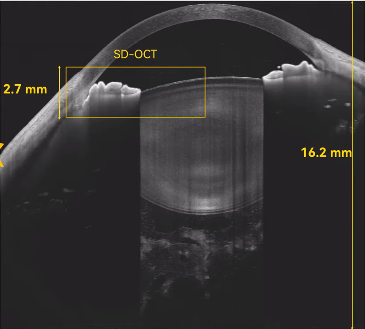 Scan Depth Anterior Segment