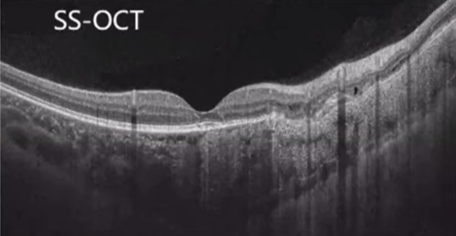SS-OCT Image