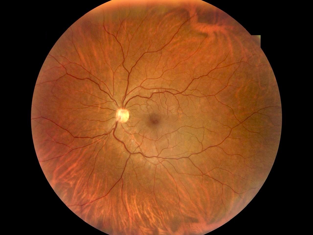 RetiCam 3100 Plus single shot Normal