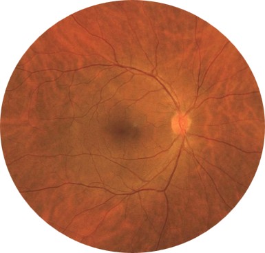 133° wide-field fundus