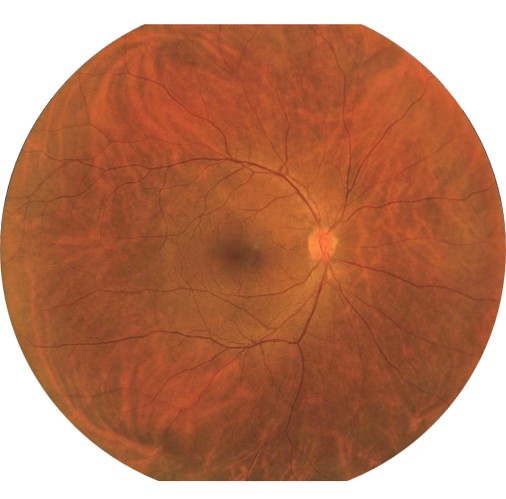 176° RetiCam 3100 Plus single shot