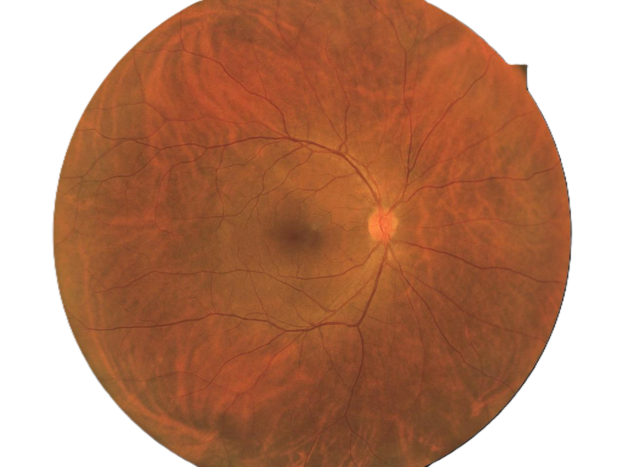 RetiCam 3100 Plus single shot