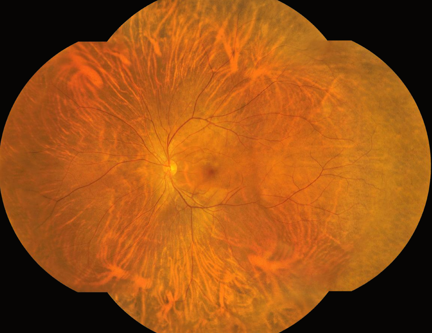 RetiCam 3100 Plus widefield mosaic