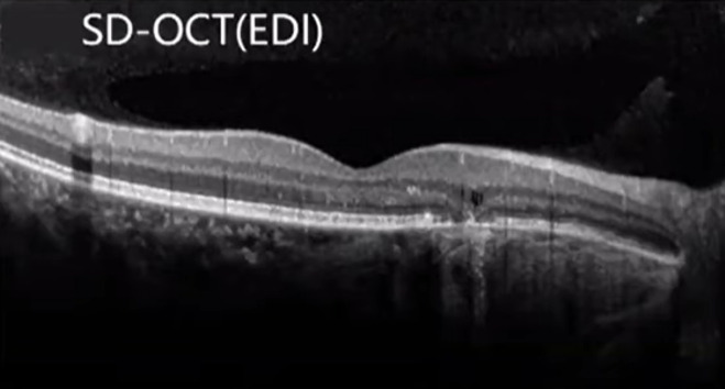 SD-OCT Image