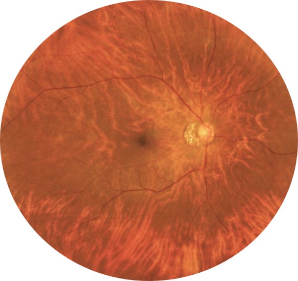 133° wide-field fundus