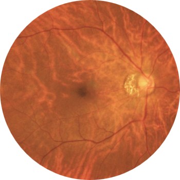 45° standard fundus field